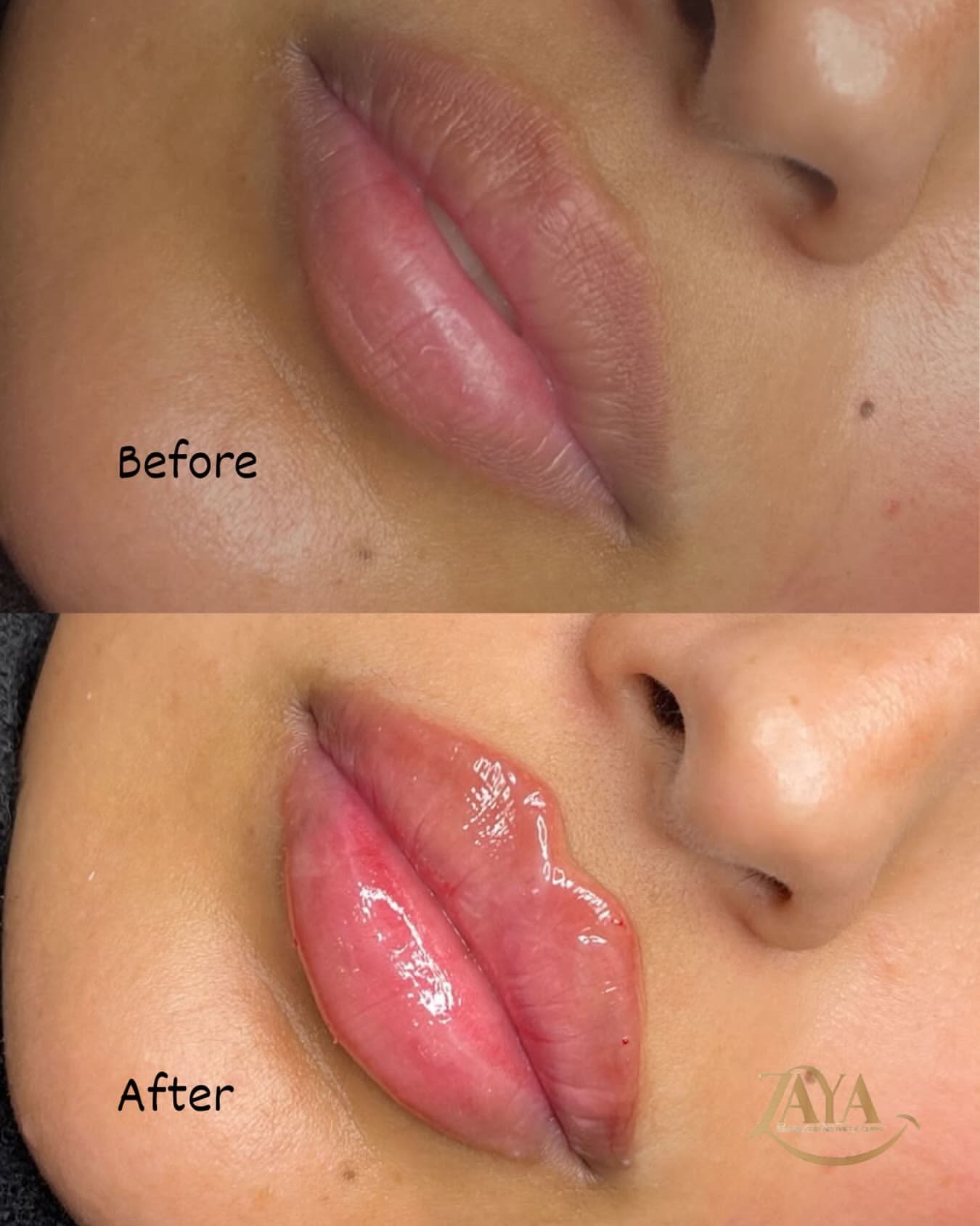 ZAYA Clinic Lip Filler Before and After