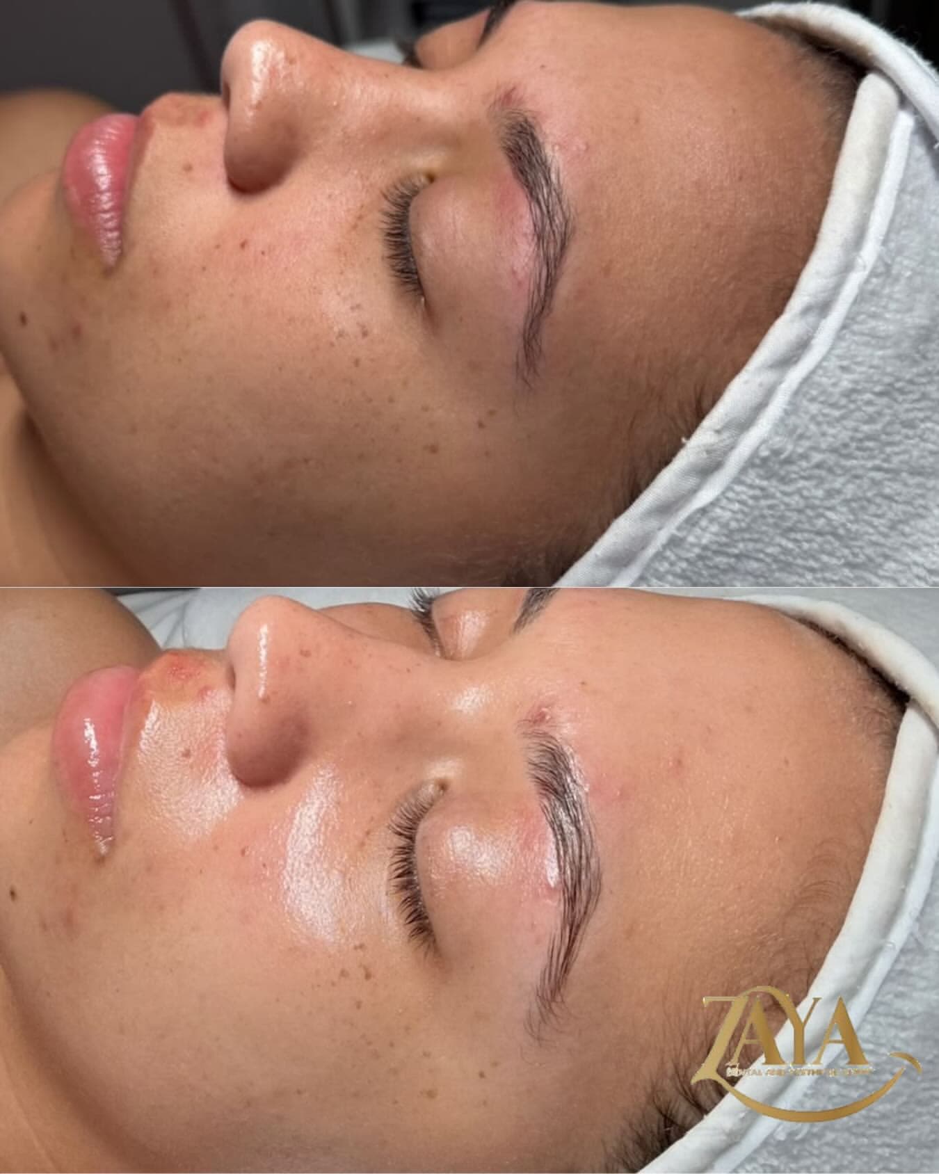 Facial Glow & Dermal Renewal
