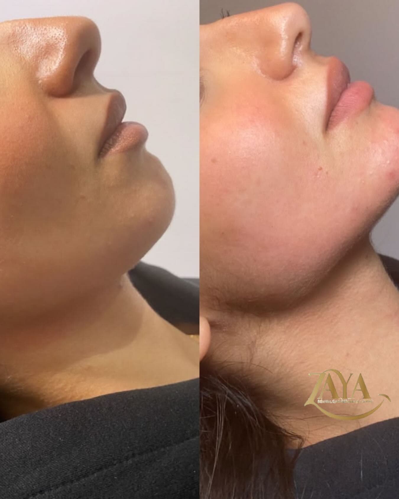 ZAYA Clinic Jawline & Chin Sculpting
